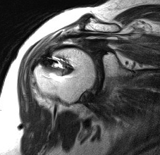 Shoulder MRI Failed RC Repair 2
